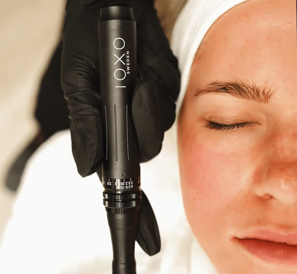 Microneedling i Stockholm