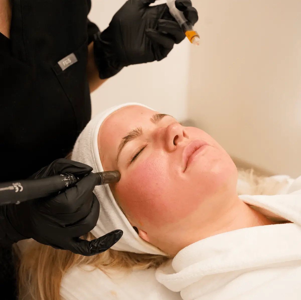 Vem passar microneedling för