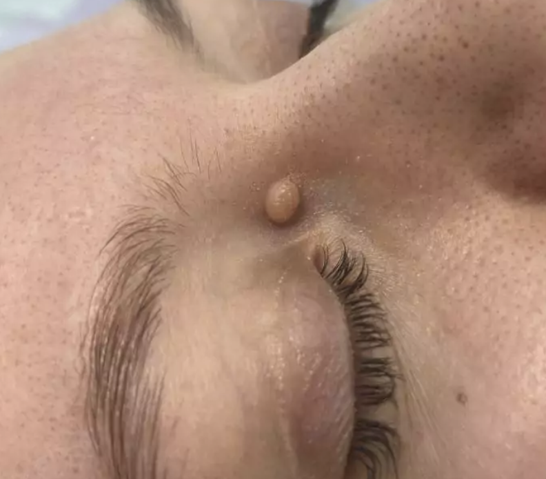 Fibrom