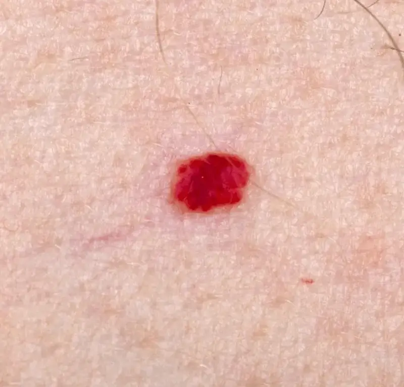 Capillary haemangioma