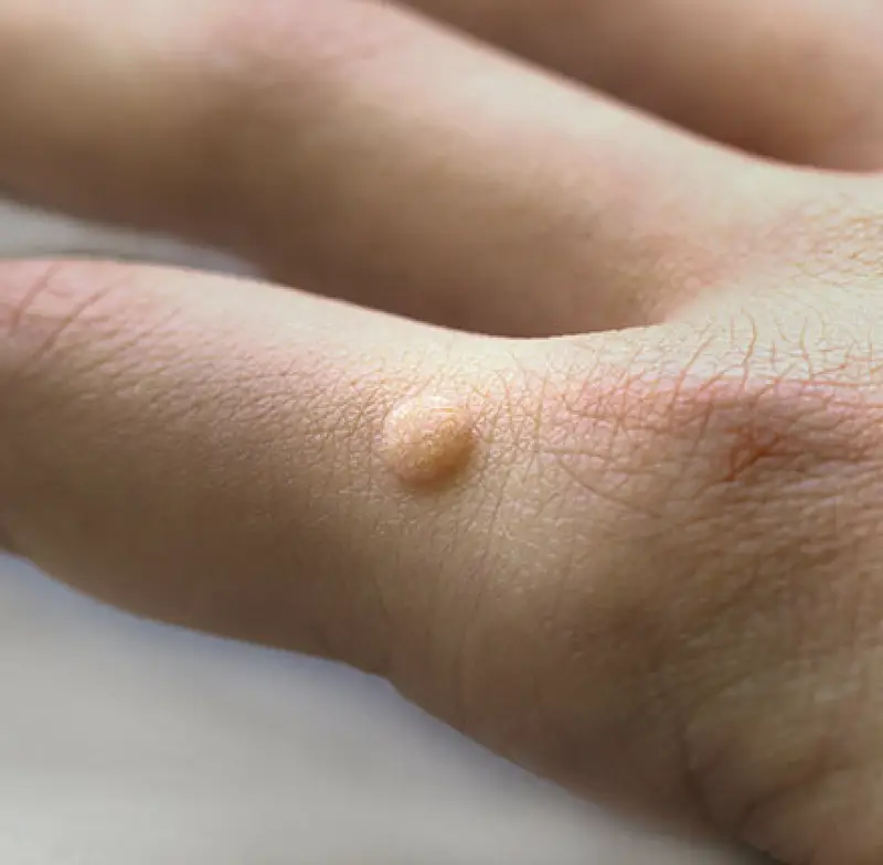 Vulgar wart