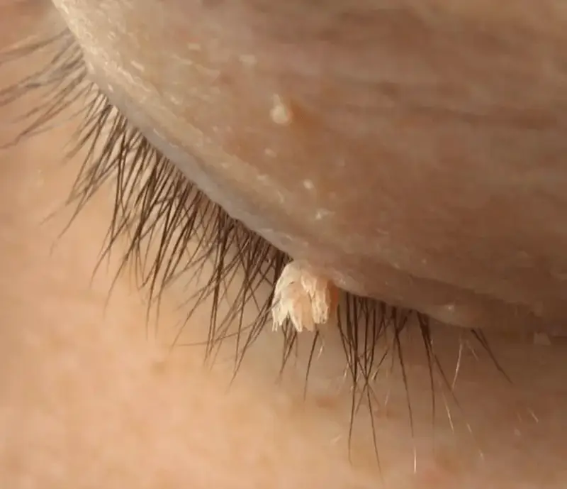 Filiform wart