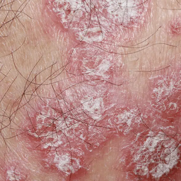 Lichen sclerosus