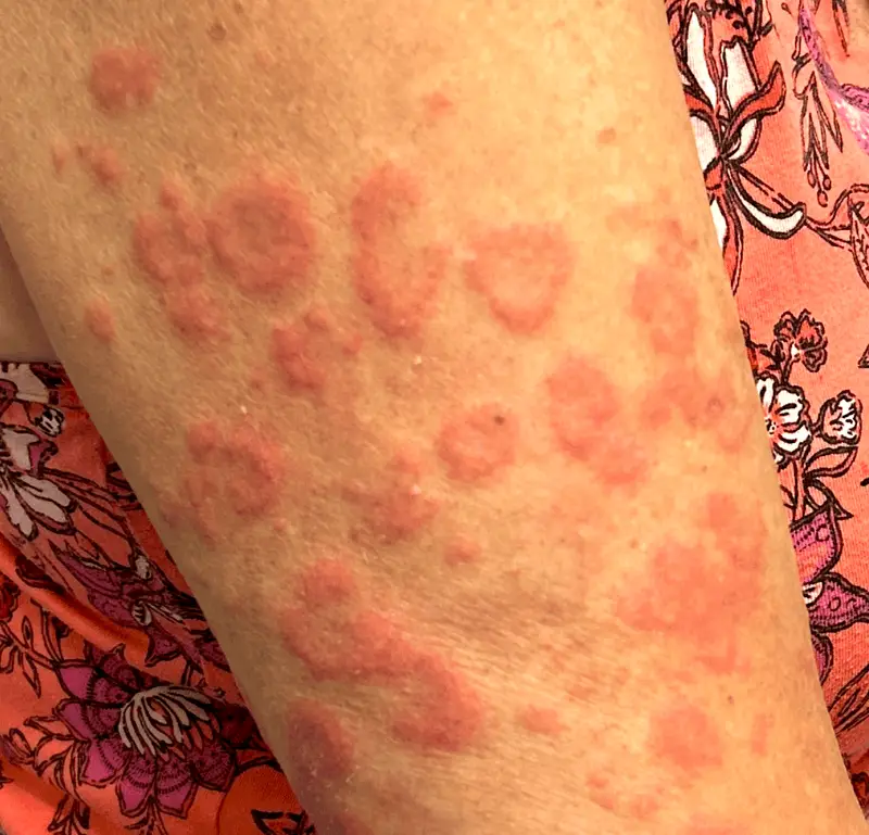 Granuloma annulare